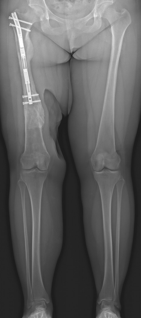Röntgenbild nach Behandlung mit Marknagel