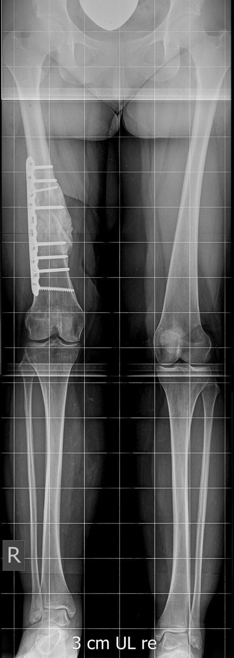 Röntgenbild verkürzter Oberschenkelknochen