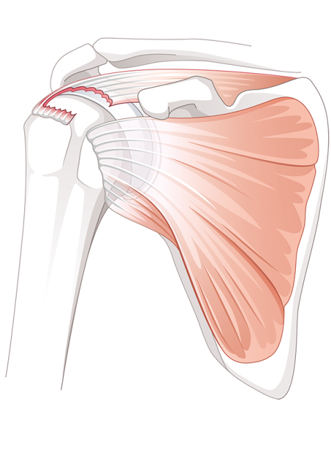 Illustration Anatomie einer Rotatorenmanschenttenruptur