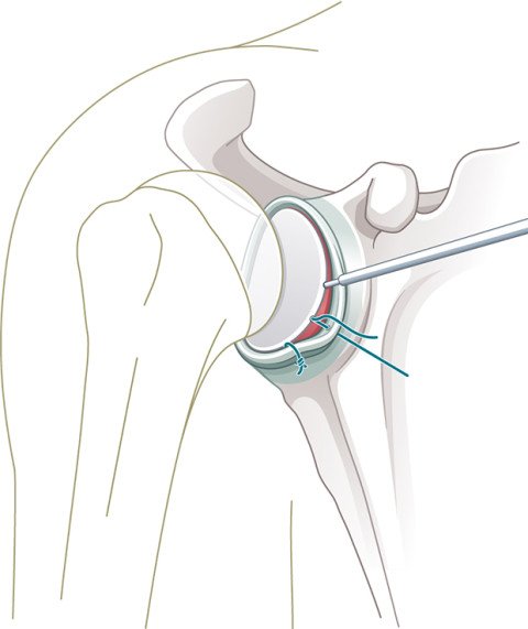 Schulterluxation: Einbringen der Knochenanker und Refixation der Gelenklippe