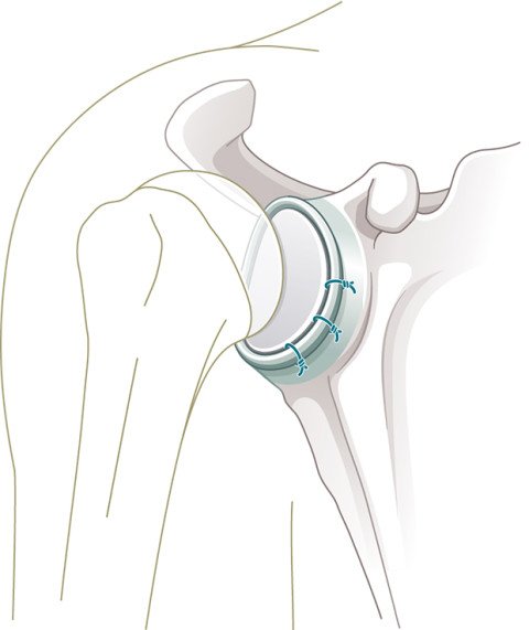 Schulterluxation: Reparierte Gelenklippe