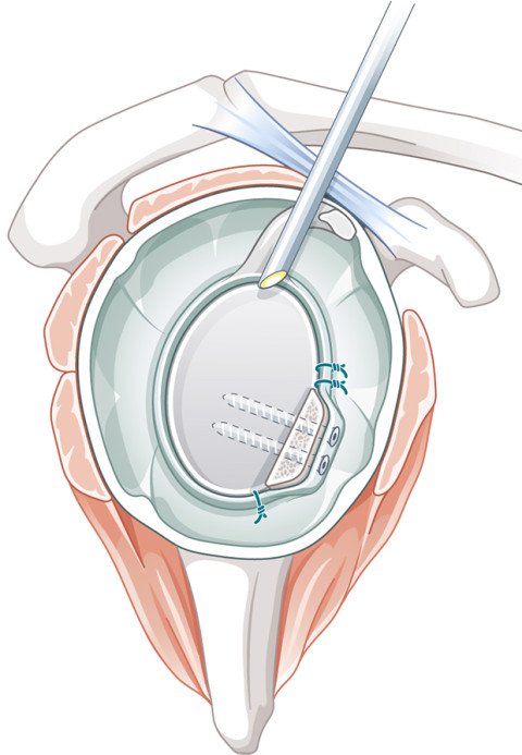 Schulterluxation: Arthroskopischer Pfannenrandaufbau mit Knochen vom Beckenkamm