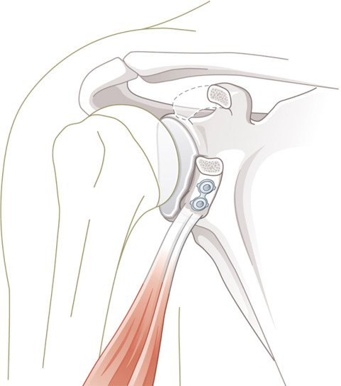Schulterluxation: Operation nach Latarjet