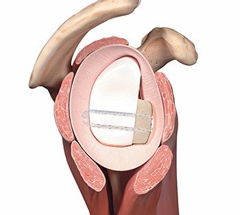 arthroskopische Spanplastik als OP-Technik in der Schulthess Klini