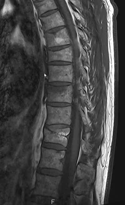 Röntgenbild Wirbelsäule mit Frakturen wegen Osteoporose