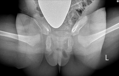 Röntgenbild Säugling mit Hüftluxation nach Operation