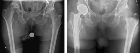 Röntgenbilder Hüftprothese bei Parkinson vor und nach OP