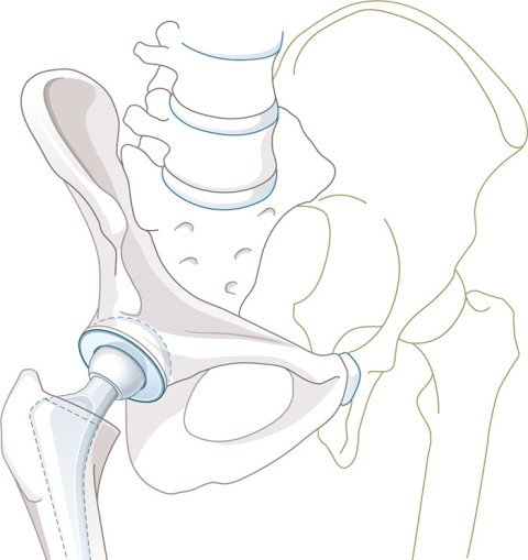 Illustration Hüftprothese