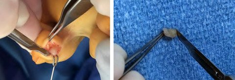 Schwannom (Tumor im Zeh), intraoperativ und nach Entfernung