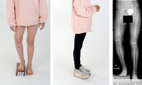Fotografien und Röntgenbild mit Beinlängendifferenz bei Morbus Ollier