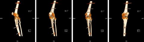 Präoperative 3D-CT-Bilder der Tibiakopffraktur