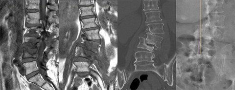 Bildgebung Spondylodiszitis