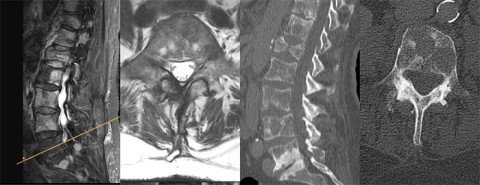 Tumor an der Wirbelsäule