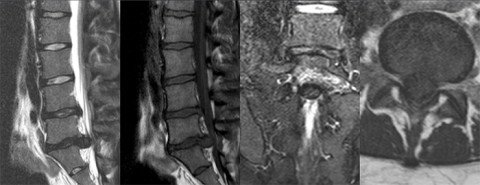 MRI Cauda equina Syndrom