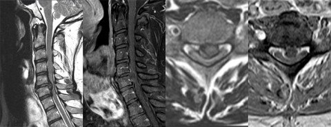 MRI cervicale Myelopathie