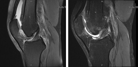 MRI-Aufnahme Knie vor und nach Knorpelchips-Implantation