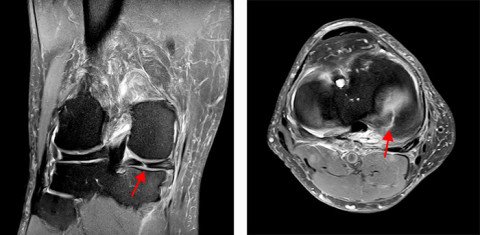 MRI-Bilder einer degenerativen Meniskusverletzung