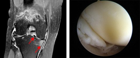 Meniskusriss MRI und Arhtroskopieaufnahme