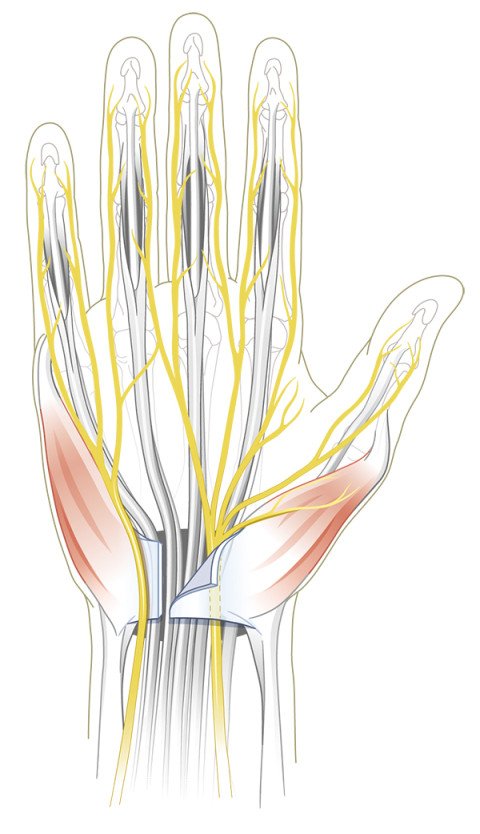 Karpaltunnelsyndrom Operation
