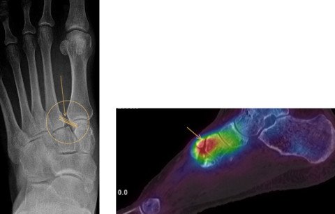 mittelfussbandverletzung_arthrose-lisfranc_abb-3-4.jpg