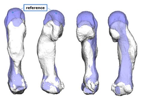 Computersimulation fehlverheilter Knochen Hand