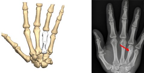 Computersimulation Hand und Röntgenbild mit fehlverheiltem Mittelhandknochen