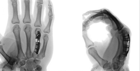 Intraoperatives Röntgenbild Korrektur Hand