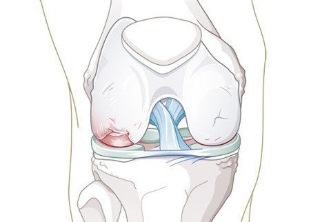 Illustration Kniearthrose