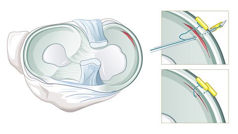 Illustration Operation Meniskusnaht