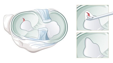 Illustration Operation Meniskusteilresektion