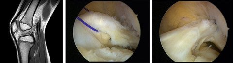 MRI und Arthroskopiebilder eines Kreuzbandrisses beim Kind