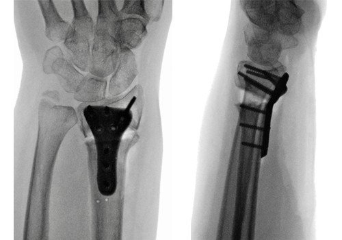 Röntgenbild während Hand-OP