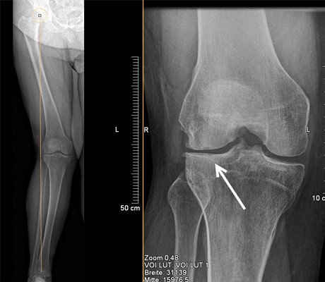 Röntgenbild 40-Jähriger mit Arthrose wegen unbehandelter Fehlstellung
