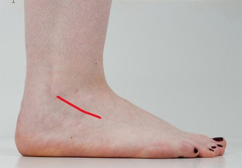 eingezeichneter Hautschnitt am Fuss über Sinus tarsi