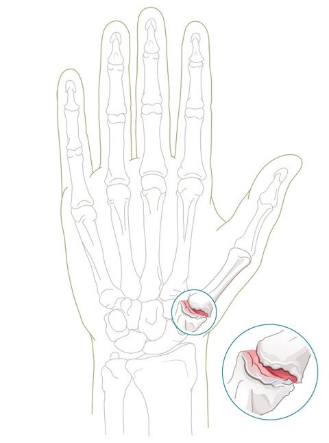 Illustration Daumensattelgelenk mit Arthrose