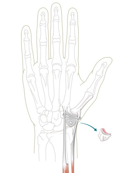 Illustration Operation bei fortgeschrittener Daumensattelgelenksarthrose