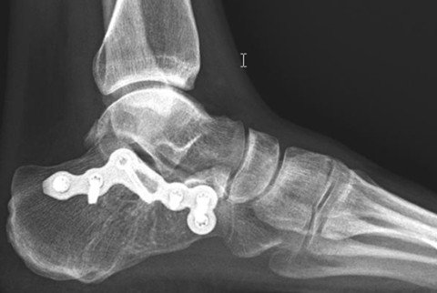 Röntgenbild Calcaneusfraktur 1 Jahr nach der Operation