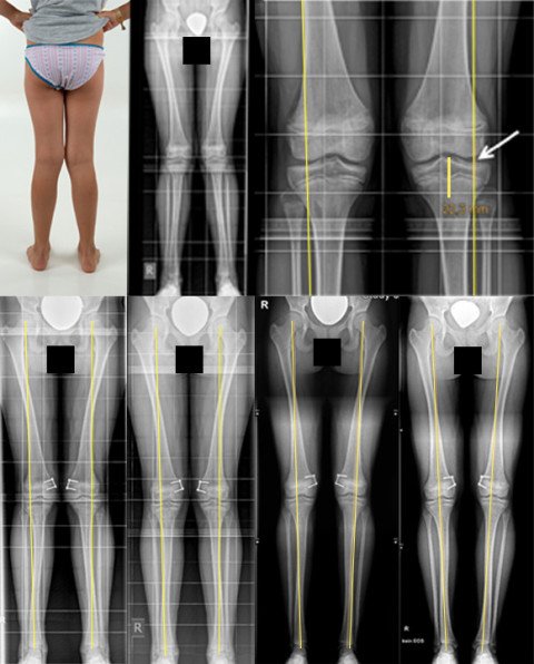 Foto und Röntgenbilder Verlauf Behandlung X-Beine