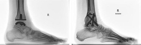 Arthrose oberes Sprunggelenk