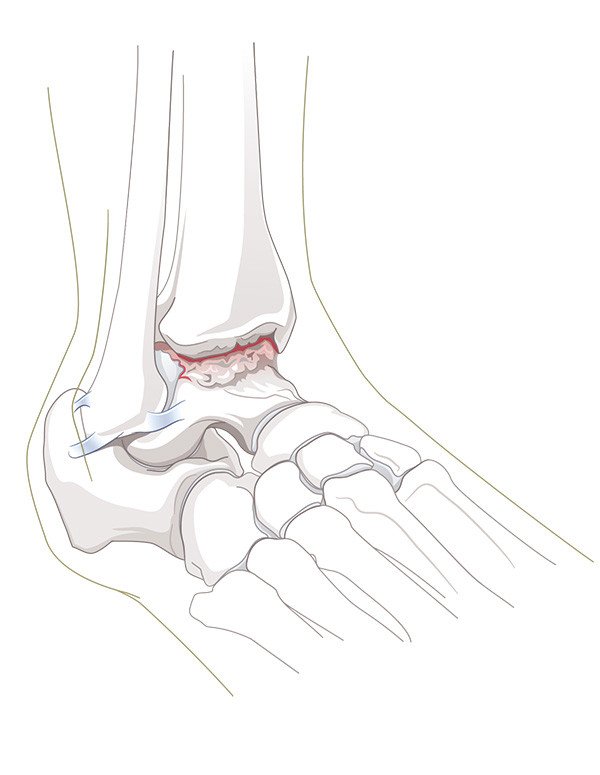 Arthrose des Sprunggelenks