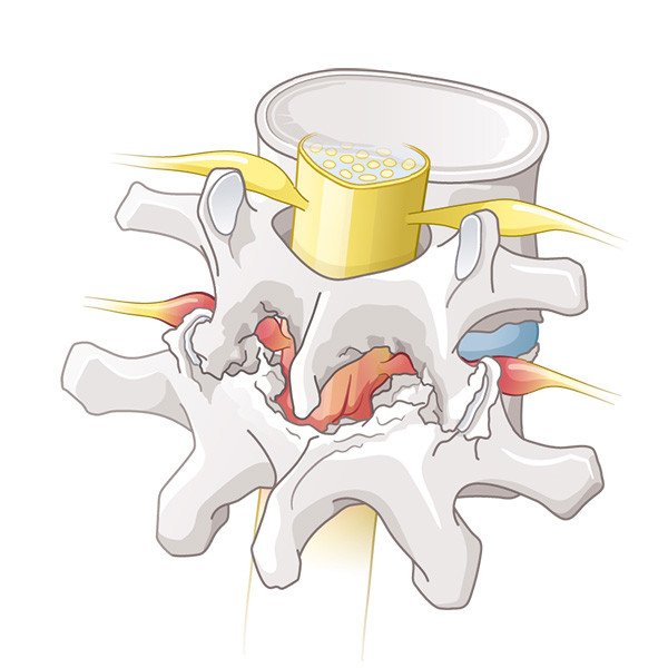Knochenanlagerungen und Verengung Spinalkanal