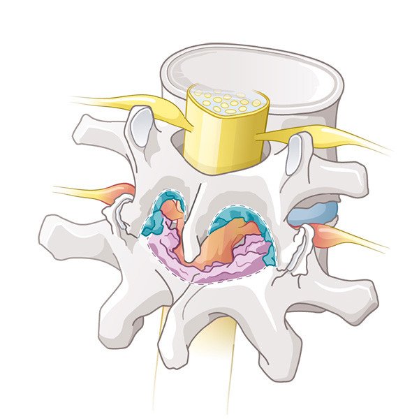 Entfernung degeneratives Gewebe
