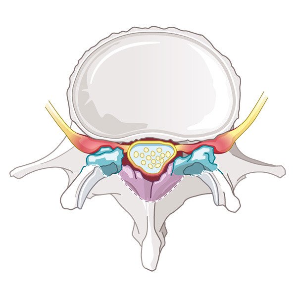 Lendenwirbelsäule im Querschnitt Spinalkanal