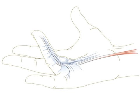 Dupuytren-Hand mit Beugekontraktur