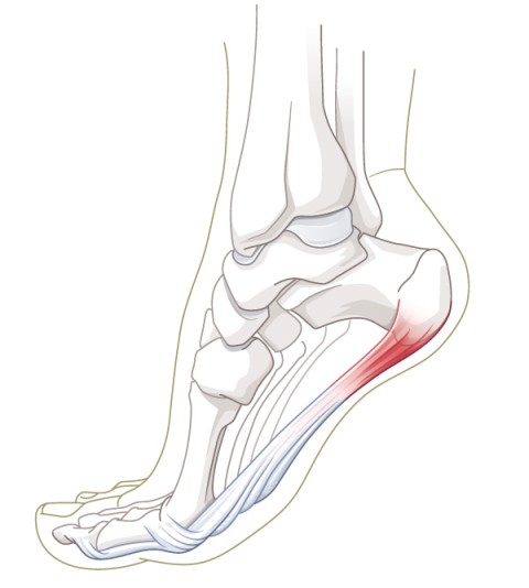 Plantaraponeurose Fersenschmerz
