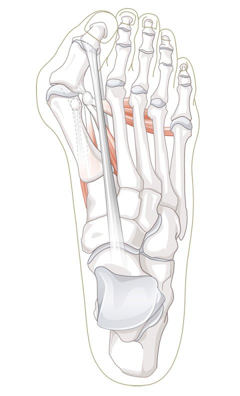 Hallux Valgus