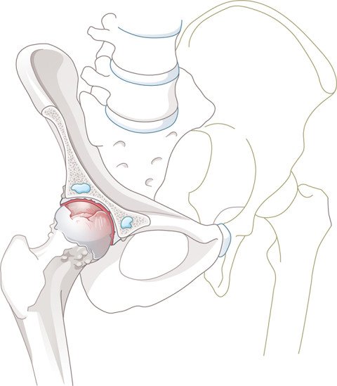 Illustration Hüftarthrose mit Zysten