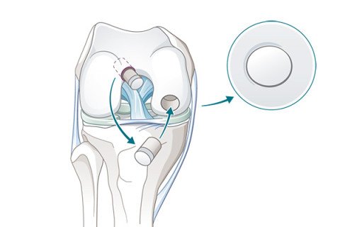 Knorpelknochentransplantation