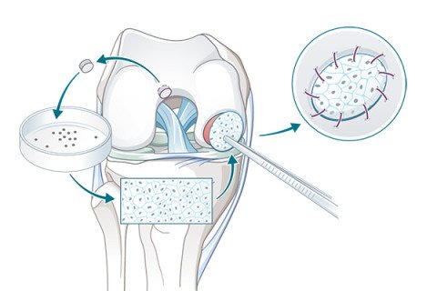 Knorpelzelltransplantation