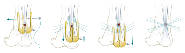 Operation Achillessehne minimal-invasive Technik